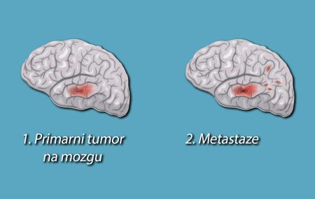 Metastaze na mozgu