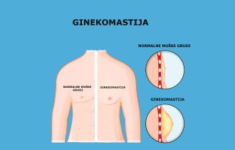 Zašto dolazi do uvećanja grudi kod muškaraca i kako se ginekomastija leči
