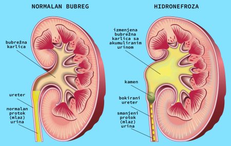 Hidronefroza