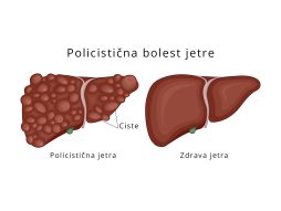 Policistična bolest jetre