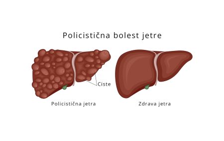 Policistična bolest jetre