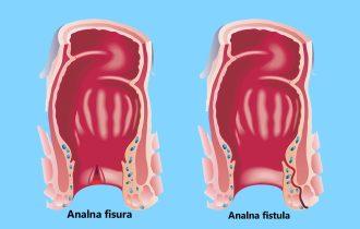 Bol i krvarenje zbog rascepa i pukotina u anusu: Šta je analna fisura, a šta fistula