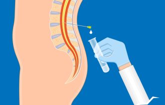 Lumbalna punkcija radi se u specifičnom položaju tela: Kako se treba pripremiti za biopsiju kičmenog stuba