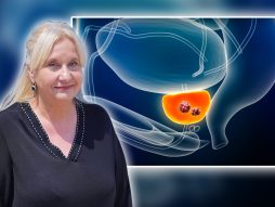 Karcinom prostate Vesna Stanojević