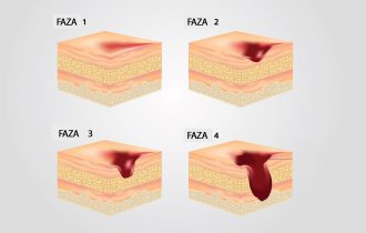 Dekubitis se prvo javlja na 5 regija tela: Kako ga prepoznati na vreme da ne dođe do infekcije opasne po život