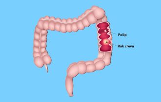Vidljivi simptom raka creva koji mnogi ignorišu: Brza reakcija je spasonosna, jer ovaj znak može ukazati na 2 karcinoma