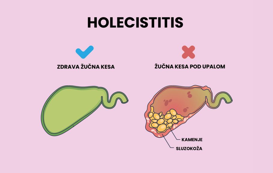 Holecistitis ilustracija