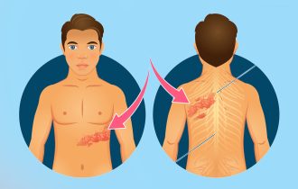 Gde se sve herpes zoster pojavljuje na telu i zašto se javlja ova virusna infekcija