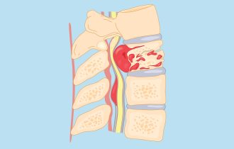 5 simptoma koji mogu da ukažu na tumor kičme: Ima četiri vrste, a neki ne daju nikakve znake