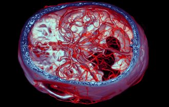 Moždana aneurizma je skrivena pretnja: Desi se a da ne znamo i može da bude fatalna