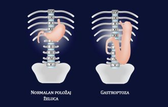 Želudac može praktično da se spusti u malu karlicu, doktor Ivica Zdravković objašnjava ima li koristi od njegovog nameštanja