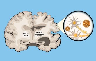 Zašto nastaje Alchajmerova bolest: Markiran glavni krivac za oboljenje koje oštećuje mozak