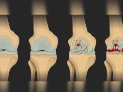 osteoartritis