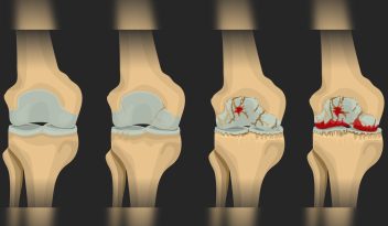 osteoartritis