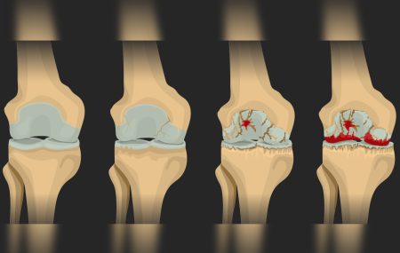 osteoartritis