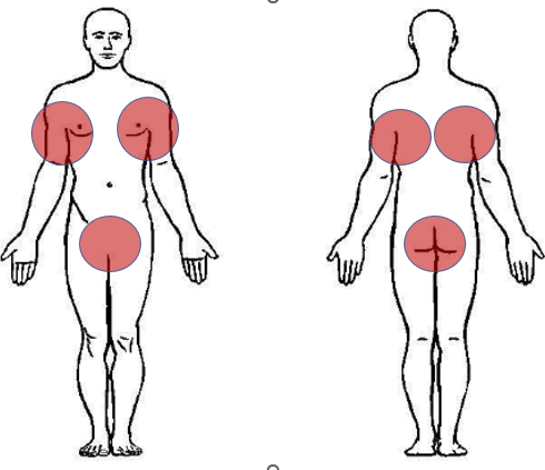 Hidradenitis zone