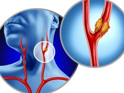 bolest karotidnih arterija