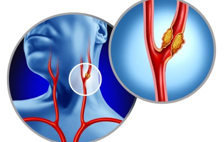 bolest karotidnih arterija