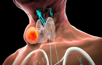 Otok ili kvržica na vratu kao znak tumora koji češće dobijaju žene: Kada je rak štitne žlezde izlečiv?