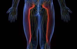 Od čega zavisi da li će išijas proći ili će izluđujući bol postati hroničan